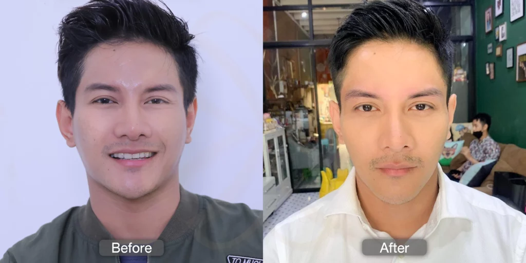 รักษาฝ้า