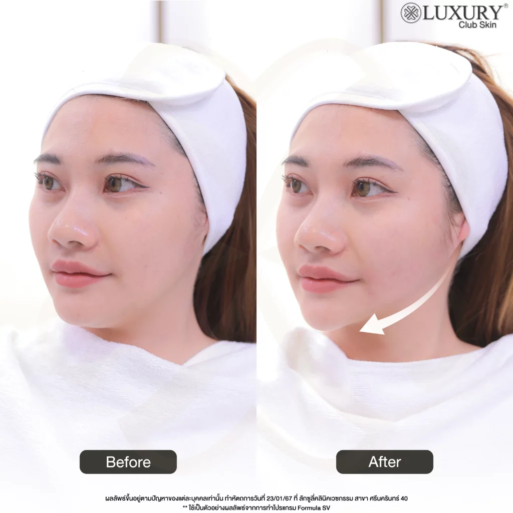 Before After