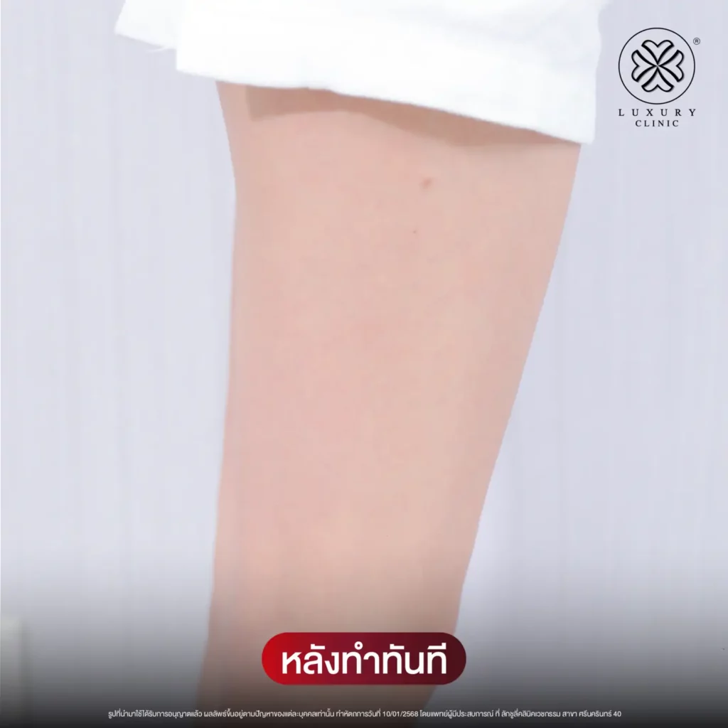 หลังทำทันที
