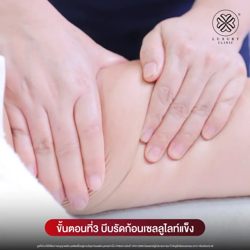 ขั้นตอนที่ 3 บีบรัดก้อนเซลลูไลท์แข็ง