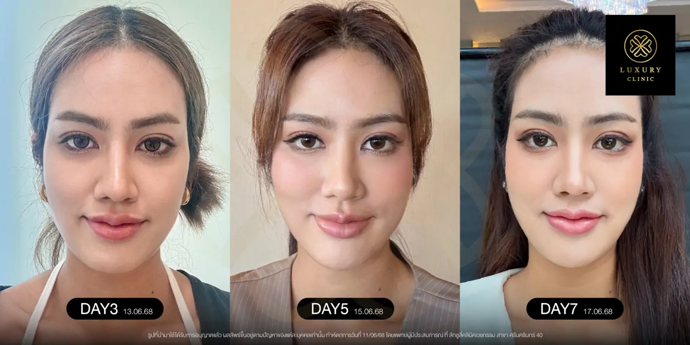 อัปเดตหลังทำ 7 วัน (After)